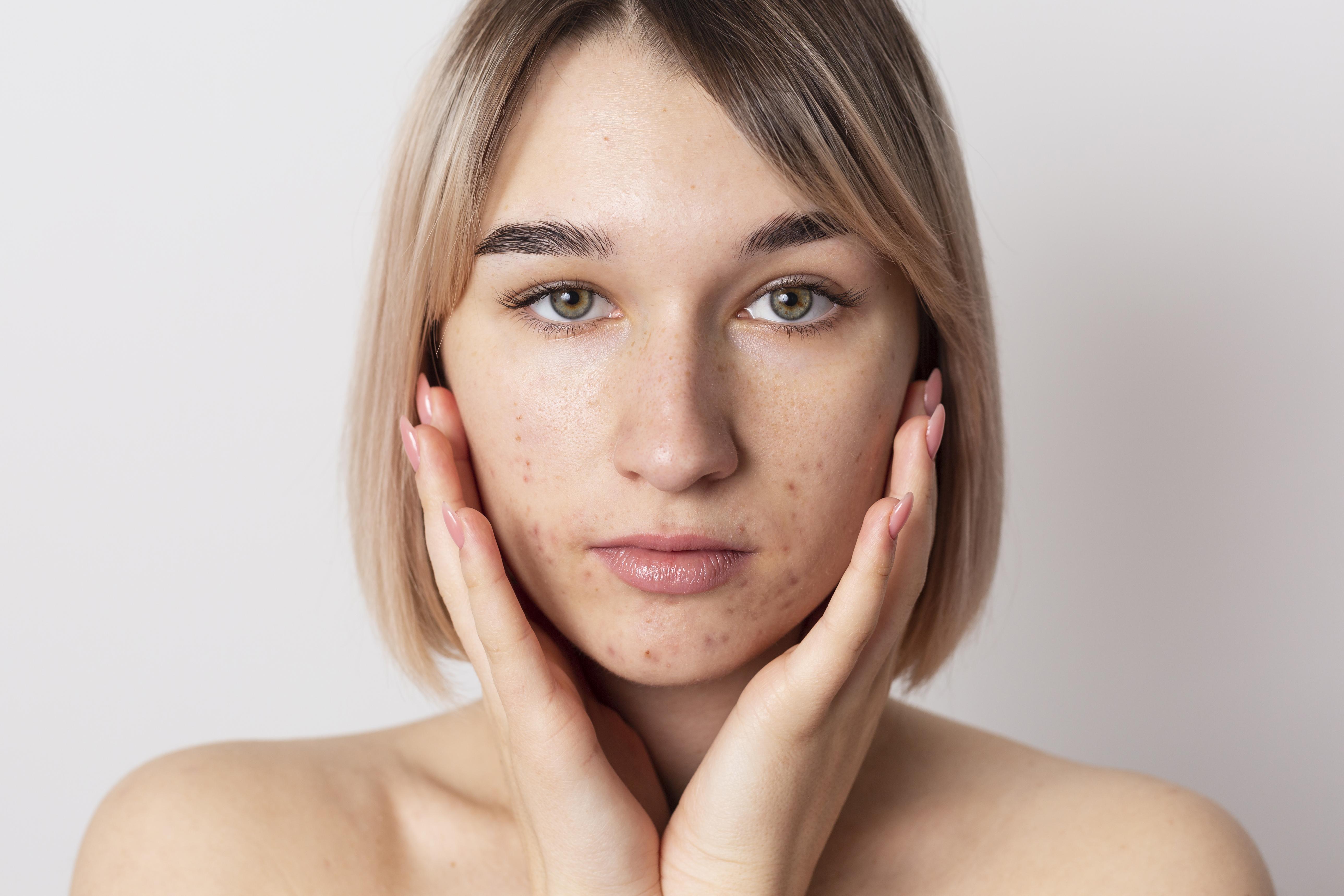 Alimentação anti-acne